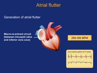 Atrial flutter
Generation of atrial flutter
Macro-re-entrant circuit
(between tricuspid valve
and inferior vena cava)
250-350 BPM
 