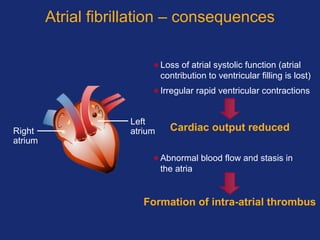 Atrial fibrillation – consequences
•Loss of atrial systolic function (atrial
contribution to ventricular filling is lost)
•Irregular rapid ventricular contractions
•Abnormal blood flow and stasis in
the atria
Cardiac output reduced
Formation of intra-atrial thrombus
Right
atrium
Left
atrium
 