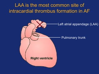 Left atrial appendage (LAA)
Pulmonary trunk
LAA is the most common site of
intracardial thrombus formation in AF
 