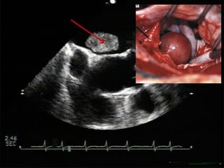 2. Unstable thrombotic mass
(transoesophageal echocardiography)
A transoesophageal view clearly shows a large
thrombus (red arrow) in the left auricle that may break
away at any moment.
 