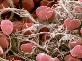 4. Fibrin threads
(scanning electron micrograph)
Fibrin forms rapidly in stagnant blood. Thrombin plays a
pivotal role in the polymerisation of the fibrin strands.
Red blood cells become trapped in the fibrin network as
the thrombus grows.
 