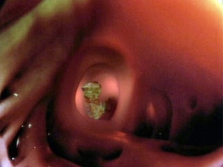 3. Thrombus formation in the left auricle
(computer graphics superimposed on in-body
photograph)
The irregular beating of the heart in atrial fibrillation
creates ideal conditions for thrombus formation in the left
auricle, especially in patients with mitral valve
insufficiency.
 