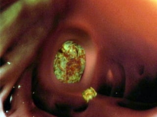 5. Fragmentation of the thrombus
(computer graphics superimposed on in-body
photograph)
As the size of the thrombotic mass increases, it
becomes more of a threat. Especially if the heart rate is
normalised, fragments of the thrombus may break away
to be swept into the circulation.
 