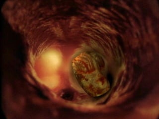 7. Cerebral thromboembolism
(computer graphics superimposed on in-body
photograph)
25 percent of the blood flow from the heart is pumped to
the brain. Cerebral thromboemboli most frequently affect
the middle cerebral artery.
 