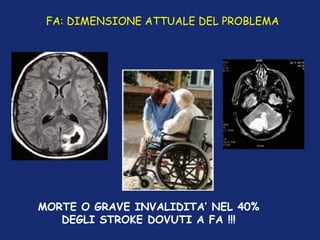 FA: DIMENSIONE ATTUALE DEL PROBLEMA
MORTE O GRAVE INVALIDITA’ NEL 40%
DEGLI STROKE DOVUTI A FA !!!
 