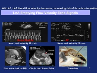 5656
Hemodynamic Changes in LAA with AF
AFSinus Rhythm
Mean peak velocity 52 cm/s Mean peak velocity 26 cm/s
Clot in the LAA on MRI Clot in the LAA on Echo Thrombus
LAA Emptying Flow Velocity Echo Signals
With AF, LAA blood flow velocity decreases, increasing risk of thrombus formation
 