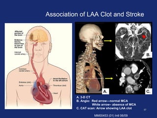 5757
A. 3-D CT
B. Angio: Red arrow—normal MCA
White arrow– absence of MCA
C. CAT scan: Arrow showing LAA clot
MM00453 (01) Intl 06/09
Association of LAA Clot and Stroke
 