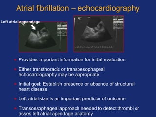 Atrial fibrillation – echocardiography
• Provides important information for initial evaluation
• Either transthoracic or transoesophageal
echocardiography may be appropriate
• Initial goal: Establish presence or absence of structural
heart disease
• Left atrial size is an important predictor of outcome
• Transoesophageal approach needed to detect thrombi or
asses left atrial apendage anatomy
Left atrial appendage
 