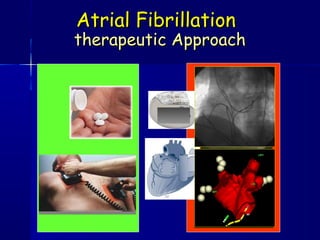 therapeutic Approachtherapeutic Approach
Atrial FibrillationAtrial Fibrillation
 