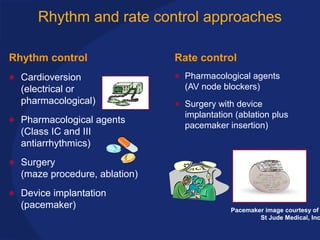 Rhythm and rate control approaches
Rhythm control
• Cardioversion
(electrical or
pharmacological)
• Pharmacological agents
(Class IC and III
antiarrhythmics)
• Surgery
(maze procedure, ablation)
• Device implantation
(pacemaker)
Rate control
• Pharmacological agents
(AV node blockers)
• Surgery with device
implantation (ablation plus
pacemaker insertion)
Pacemaker image courtesy of
St Jude Medical, Inc
 