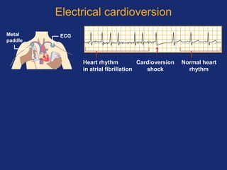 Electrical cardioversion
ECGMetal
paddle
Heart rhythm
in atrial fibrillation
Cardioversion
shock
Normal heart
rhythm
 
