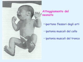Atteggiamento del
neonato
• ipertono flessori degli arti
• ipotonia muscoli del collo
• ipotonia muscoli del tronco

 
