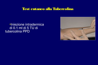 Test cutaneo alla Tubercolina
•Iniezione intradermica
di 0.1 ml di 5 TU di
tubercolina PPD
 