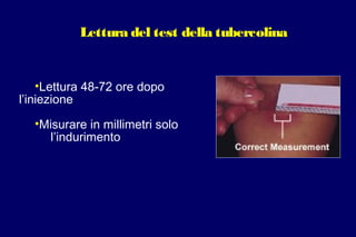 Lettura del test della tubercolina
•Lettura 48-72 ore dopo
l’iniezione
•Misurare in millimetri solo
l’indurimento
 