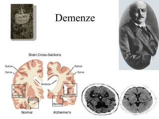 Demenze
 