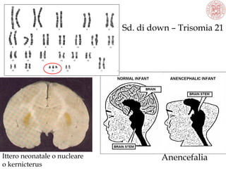 Ittero neonatale o nucleare
o kernicterus
Anencefalia
Sd. di down – Trisomia 21
 