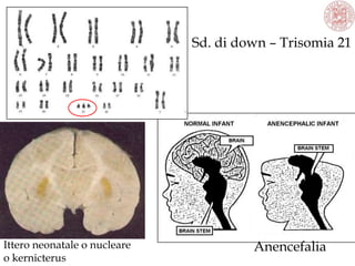 Ittero neonatale o nucleare
o kernicterus
Anencefalia
Sd. di down – Trisomia 21
 