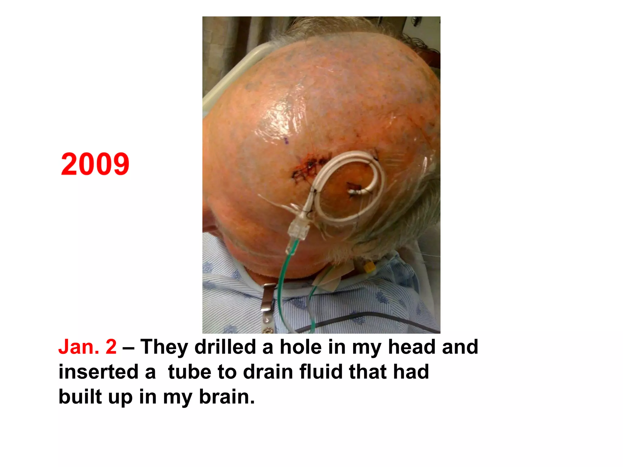 Jan. 2 – They drilled a hole in my head and
inserted a tube to drain fluid that had
built up in my brain.
 