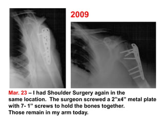 Mar. 23 – I had Shoulder Surgery again in the
same location. The surgeon screwed a 2”x4” metal plate
with 7- 1” screws to hold the bones together.
Those remain in my arm today.
 