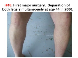 #18. First major surgery. Separation of
both legs simultaneously at age 44 in 2000.
 