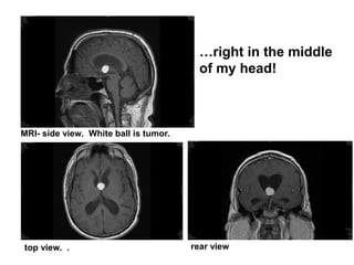 MRI- side view. White ball is tumor.
top view. . rear view
…right in the middle
of my head!
 