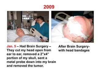 Jan. 5 – Had Brain Surgery –
They cut my head open from
ear to ear, removed a 2”x4”
portion of my skull, sent a
metal probe down into my brain
and removed the tumor.
After Brain Surgery-
with head bandages
2009
 