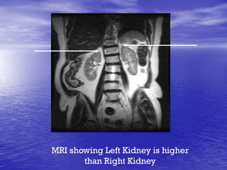 MRI showing Left Kidney is higher
than Right Kidney
 