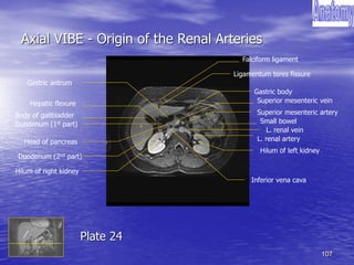 107
Axial VIBE - Origin of the Renal Arteries
L. renal artery
Hilum of right kidney
Gastric body
Gastric antrum
Small bowel
Body of gallbladder
Inferior vena cava
Superior mesenteric vein
Ligamentum teres fissure
Superior mesenteric artery
Head of pancreas
Hilum of left kidney
Hepatic flexure
L. renal vein
Duodenum (1st part)
Duodenum (2nd part)
Falciform ligament
Plate 24
 