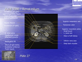 108
Axial VIBE - Renal Hilum
Quadratus lumborum
Hilum of right kidney
Hilum of left kidney
Duodenum (2st part)
Small bowel
L. renal vein
Body of gallbladder
Inferior vena cava
Ligamentum teres fissure
Head of pancreas
Duodenum (3nd part)
R. renal pelvis
Renal pelvis fat
Transverse colon
Deep back muscles
Hepatic flexure
Psoas muscle
Superior mesenteric artery
Hepatorenal recess
(Morrison’s pouch)
Superior mesenteric vein
Plate 27
 