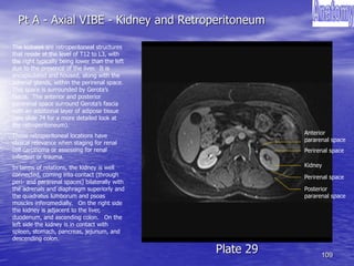 109
Pt A - Axial VIBE - Kidney and Retroperitoneum
Plate 29
The kidneys are retroperitoneal structures
that reside at the level of T12 to L3, with
the right typically being lower than the left
due to the presence of the liver. It is
encapsulated and housed, along with the
adrenal glands, within the perirenal space.
This space is surrounded by Gerota’s
fascia. The anterior and posterior
pararenal space surround Gerota’s fascia
with an additional layer of adipose tissue
(see slide 74 for a more detailed look at
the retroperitoneum).
These retroperitoneal locations have
clinical relevance when staging for renal
cell carcinoma or assessing for renal
infection or trauma.
In terms of relations, the kidney is well
connected, coming into contact (through
peri- and pararenal spaces) bilaterally with
the adrenals and diaphragm superiorly and
the quadratus lumborum and psoas
muscles inferomedially. On the right side
the kidney is adjacent to the liver,
duodenum, and ascending colon. On the
left side the kidney is in contact with
spleen, stomach, pancreas, jejunum, and
descending colon.
Posterior
pararenal space
Perirenal space
Kidney
Perirenal space
Anterior
pararenal space
 
