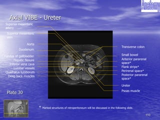 110
Axial VIBE - Ureter
Transverse colon
Deep back muscles
Ureter
Hepatic flexure
Quadratus lumborum
Psoas muscle
Superior mesenteric
artery
Small bowel
Superior mesenteric
vein
Fundus of gallbladder
Anterior pararenal
space*
Posterior pararenal
space*
Perirenal space*
Lumbar vessels
Inferior vena cava
Aorta
Flank stripe*
Duodenum
* Marked structures of retroperitoneum will be discussed in the following slide.
Plate 30
 