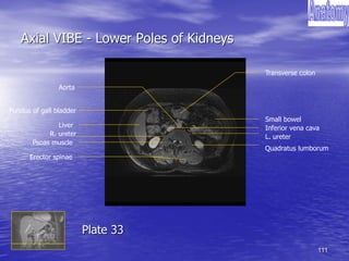 111
Axial VIBE - Lower Poles of Kidneys
Transverse colon
Quadratus lumborum
Psoas muscle
Small bowel
Inferior vena cava
Fundus of gall bladder
Aorta
L. ureter
Erector spinae
Liver
R. ureter
Plate 33
 