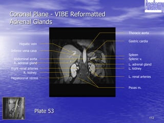 112
Coronal Plane - VIBE Reformatted
Adrenal Glands
Thoracic aorta
Hepatic vein
Hepatorenal recess
R. kidney
Spleen
Psoas m.
L. kidney
Splenic v.
Right renal arteries
L. renal arteries
Inferior vena cava
R. adrenal gland L. adrenal gland
Gastric cardia
Abdominal aorta
Plate 53
 