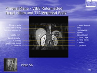 113
Coronal Plane - VIBE Reformatted
Renal Hilum and T12 Vertebral Body
Thoracic aorta
Hemiazygos v
Hepatic vein
Serratus anterior m.
Renal sinus fat
Hepatorenal recess
R. kidney
R. lower lobe of lung
L. lower lobe of
lung
Spleen
R. psoas m.
L. renal pelvis
L. kidney
L. renal calyx
Splenic hilum
L. psoas m.
Plate 56
 