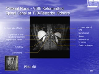 114
Coronal Plane - VIBE Reformatted
Spinal Canal at T10/Posterior Kidneys
Right lobe of liver
(posterior segment)
Spinal canal
Spleen
Spinal cord
Perirenal fat
Erector spinae m.
Hepatorenal recess
R. lower lobe of lung
R. kidney
L. lower lobe of
lung
L. kidney
Plate 60
 