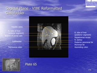 115
Sagittal Plane - VIBE Reformatted
Gallbladder
Gallbladder
Perirenal fat
Posterior pararenal fat
Hepatorenal recess
Ascending colon
R. kidney
R. lobe of liver
(posterior segment)
R. lobe of liver
(anterior segment)
Branch of portal vein
Transverse colon
Hepatic veins
Plate 65
 