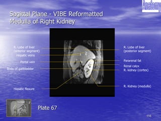 116
Sagittal Plane - VIBE Reformatted
Medulla of Right Kidney
Body of gallbladder
Hepatic veins
Renal calyx
Pararenal fat
R. kidney (cortex)
R. Kidney (medulla)
Portal vein
R. Lobe of liver
(anterior segment)
R. Lobe of liver
(posterior segment)
Hepatic flexure
Plate 67
 