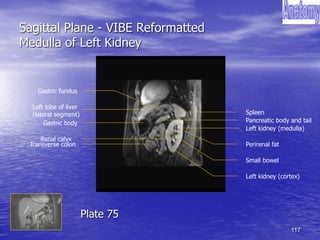 117
Sagittal Plane - VIBE Reformatted
Medulla of Left Kidney
Gastric body
Left lobe of liver
(lateral segment)
Left kidney (medulla)
Transverse colon
Left kidney (cortex)
Spleen
Gastric fundus
Renal calyx
Pancreatic body and tail
Small bowel
Perirenal fat
Plate 75
 