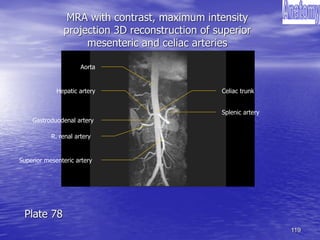 119
MRA with contrast, maximum intensity
projection 3D reconstruction of superior
mesenteric and celiac arteries
Aorta
Hepatic artery
R. renal artery
Superior mesenteric artery
Celiac trunk
Splenic artery
Gastroduodenal artery
Plate 78
 