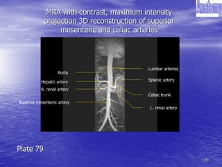 120
MRA with contrast, maximum intensity
projection 3D reconstruction of superior
mesenteric and celiac arteries
Aorta
Hepatic artery Splenic artery
Celiac trunk
Superior mesenteric artery
Lumbar arteries
L. renal artery
R. renal artery
Plate 79
 