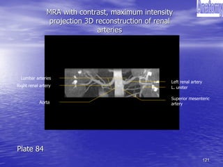 121
MRA with contrast, maximum intensity
projection 3D reconstruction of renal
arteries
Right renal artery
Left renal artery
Aorta
Superior mesenteric
artery
Lumbar arteries
L. ureter
Plate 84
 