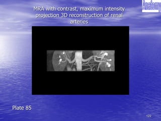 122
MRA with contrast, maximum intensity
projection 3D reconstruction of renal
arteries
Plate 85
 