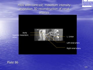 123
MRA with contrast, maximum intensity
projection 3D reconstruction of renal
arteries
Superior mesenteric
artery
Aorta
L. Ureter
Right renal artery
Left renal artery
Plate 86
 