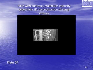 124
MRA with contrast, maximum intensity
projection 3D reconstruction of renal
arteries
Plate 87
 