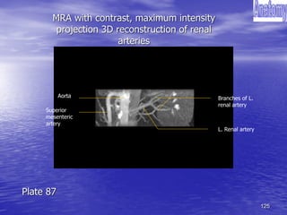 125
MRA with contrast, maximum intensity
projection 3D reconstruction of renal
arteries
Aorta
Superior
mesenteric
artery
L. Renal artery
Branches of L.
renal artery
Plate 87
 