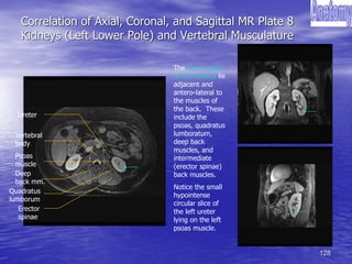 128
Correlation of Axial, Coronal, and Sagittal MR Plate 8
Kidneys (Left Lower Pole) and Vertebral Musculature
Vertebral
body
Quadratus
lumborum
Erector
spinae
Psoas
muscle
Ureter
The lower poles
of the kidneys lie
adjacent and
antero-lateral to
the muscles of
the back. These
include the
psoas, quadratus
lumboratum,
deep back
muscles, and
intermediate
(erector spinae)
back muscles.
Notice the small
hypointense
circular slice of
the left ureter
lying on the left
psoas muscle.
Deep
back mm.
 