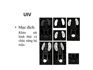 UIV
• Mục đích:
Khảo sát
hình thái và
chức năng hệ
niệu.
 