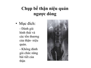 Chụp bể thận niệu quản
ngược dòng
• Mục đích:
- Đánh giá
hình thái và
các tổn thương
của thận- niệu
quản.
- Không đánh
giá chức năng
bài tiết của
thận
 