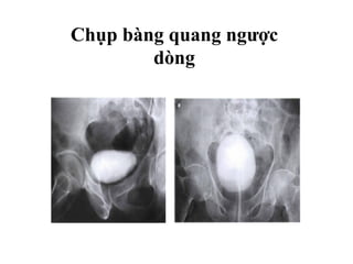Chụp bàng quang ngược
dòng
 