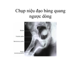 Chụp niệu đạo bàng quang
ngược dòng
 